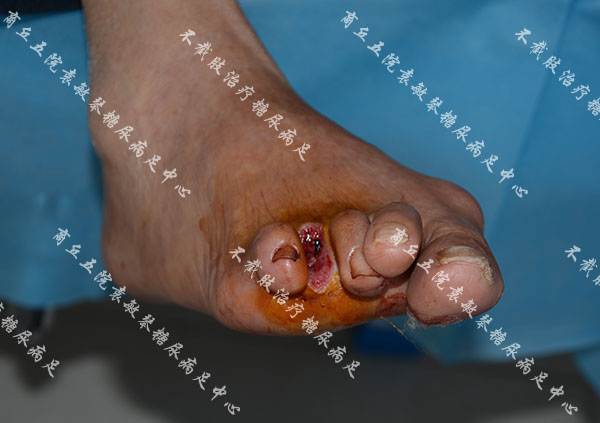 袁敏琴：糖尿病人为什么会烂脚？引起烂脚的原因有哪些？