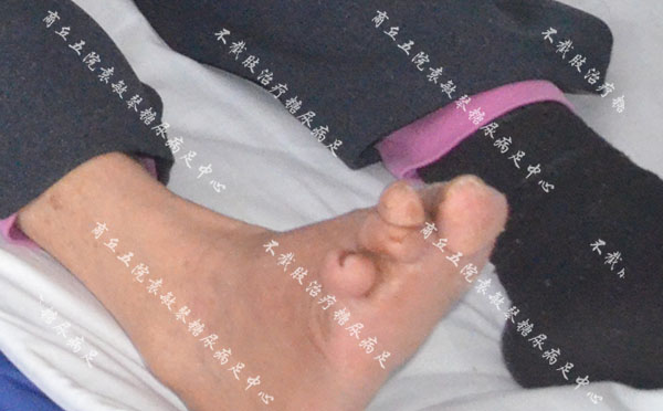 袁敏琴：糖尿病人为什么会烂脚？引起烂脚的原因有哪些？